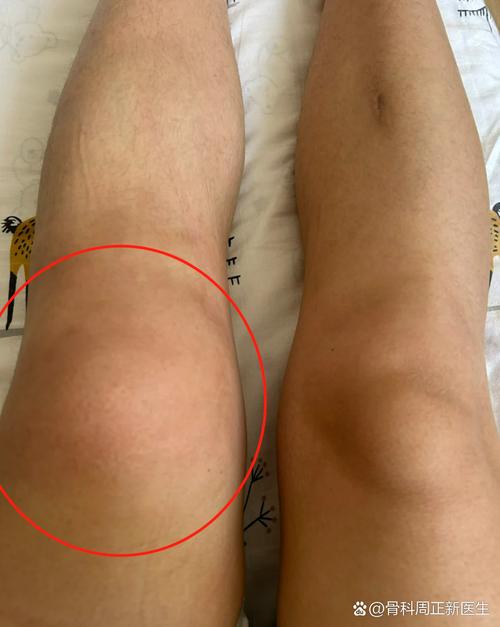 风湿 膝盖 肘 脚跟