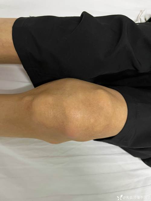 风湿 膝盖 肘 脚跟