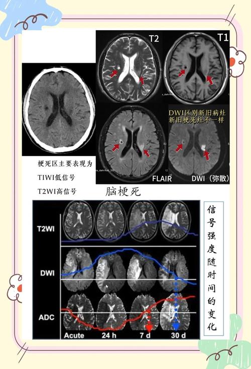 新旧脑梗ct怎么区分