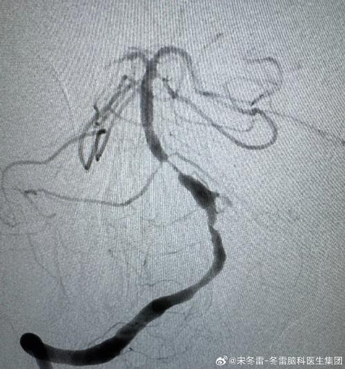 右侧基底动脉脑梗预后
