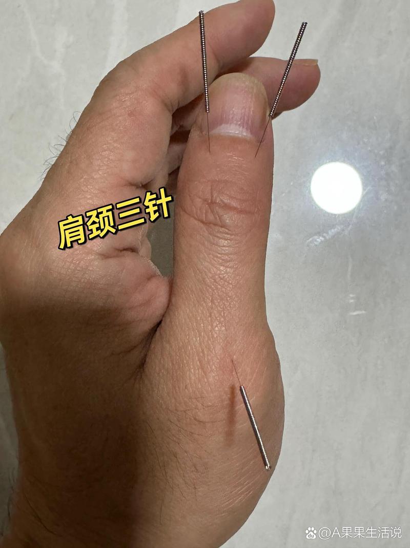 肩周炎dian针穴位