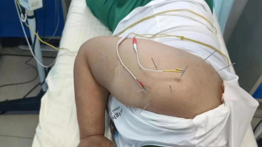 肩周炎dian针穴位