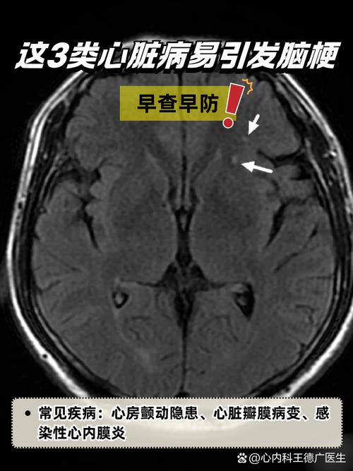 心脏瓣膜脱落引发脑梗