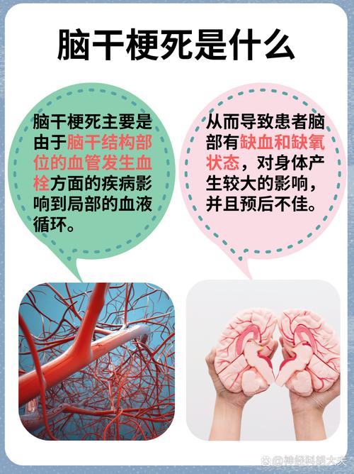 心脏瓣膜脱落引发脑梗