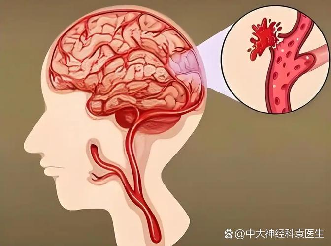 脑梗可以通过颈部淤血