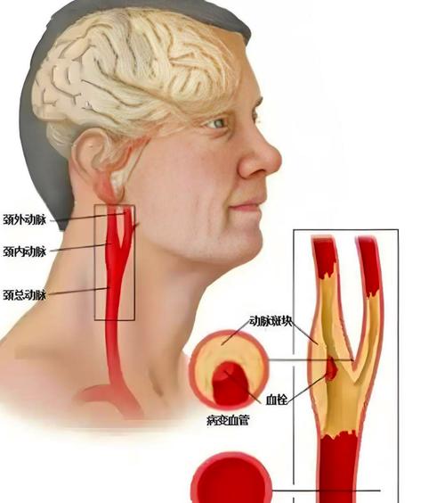 脑梗可以通过颈部淤血