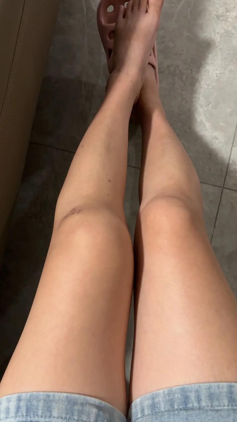 脑梗病人右腿肌肉萎缩