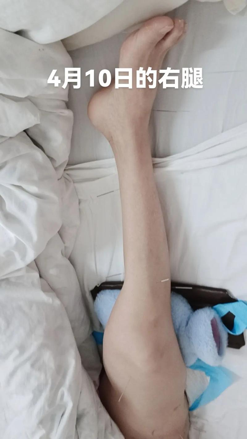 脑梗病人右腿肌肉萎缩