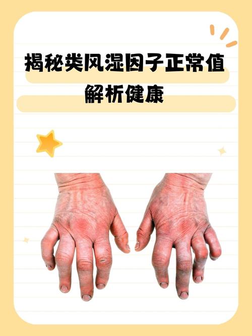 类风湿因子41.38