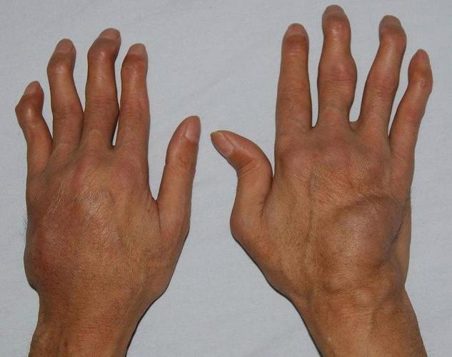 其他风湿病症状风湿病