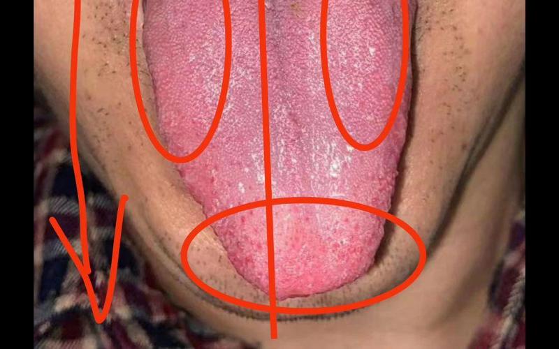 脑梗病人舌头貌似缩短
