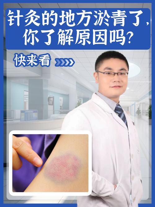 中医 穴位 治疗疤痕