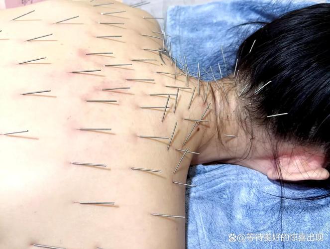 中医 穴位 治疗疤痕