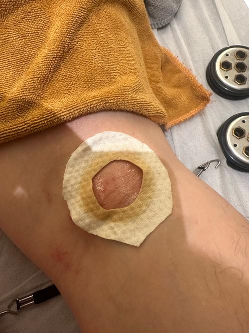 中医 穴位 治疗疤痕