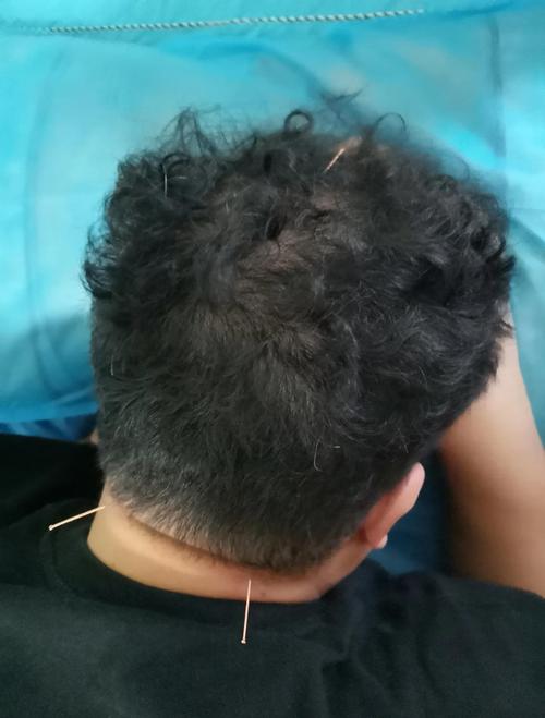 脑梗无法说话针灸哪里