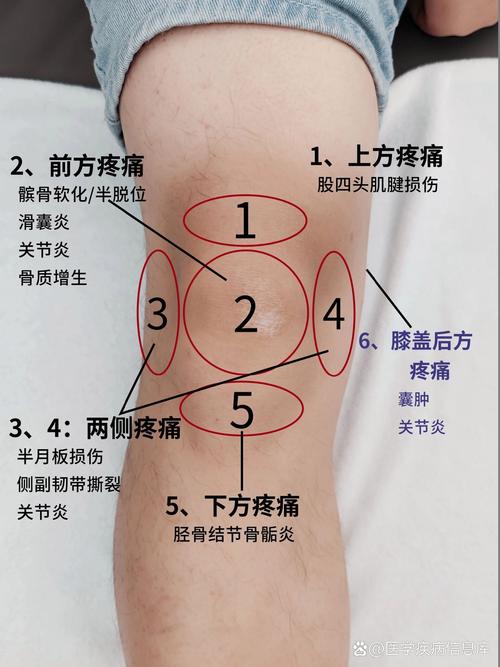 风湿及类风湿膝关节痛