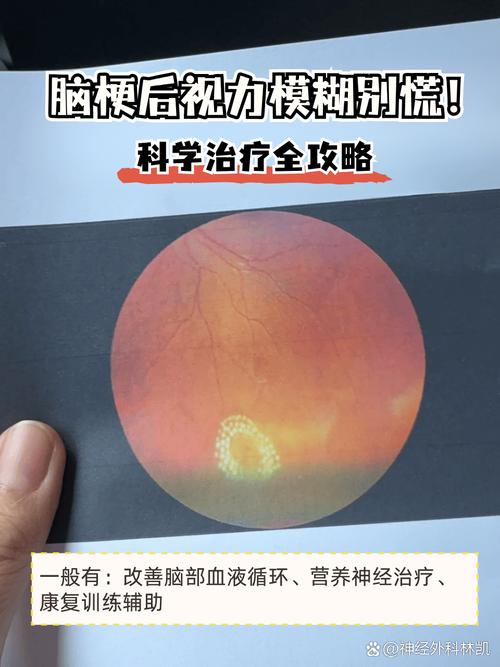 脑梗影响视力恢复正常