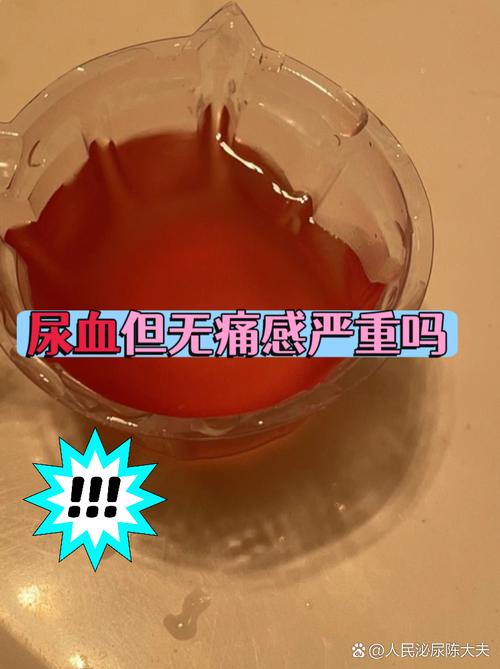 卧床脑梗老人尿液发红