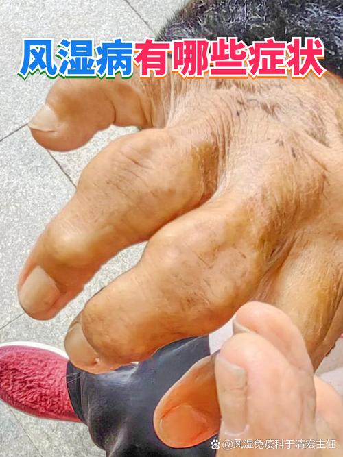 风湿热郁证是风湿病吗