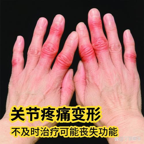 风湿风湿性关节炎症状