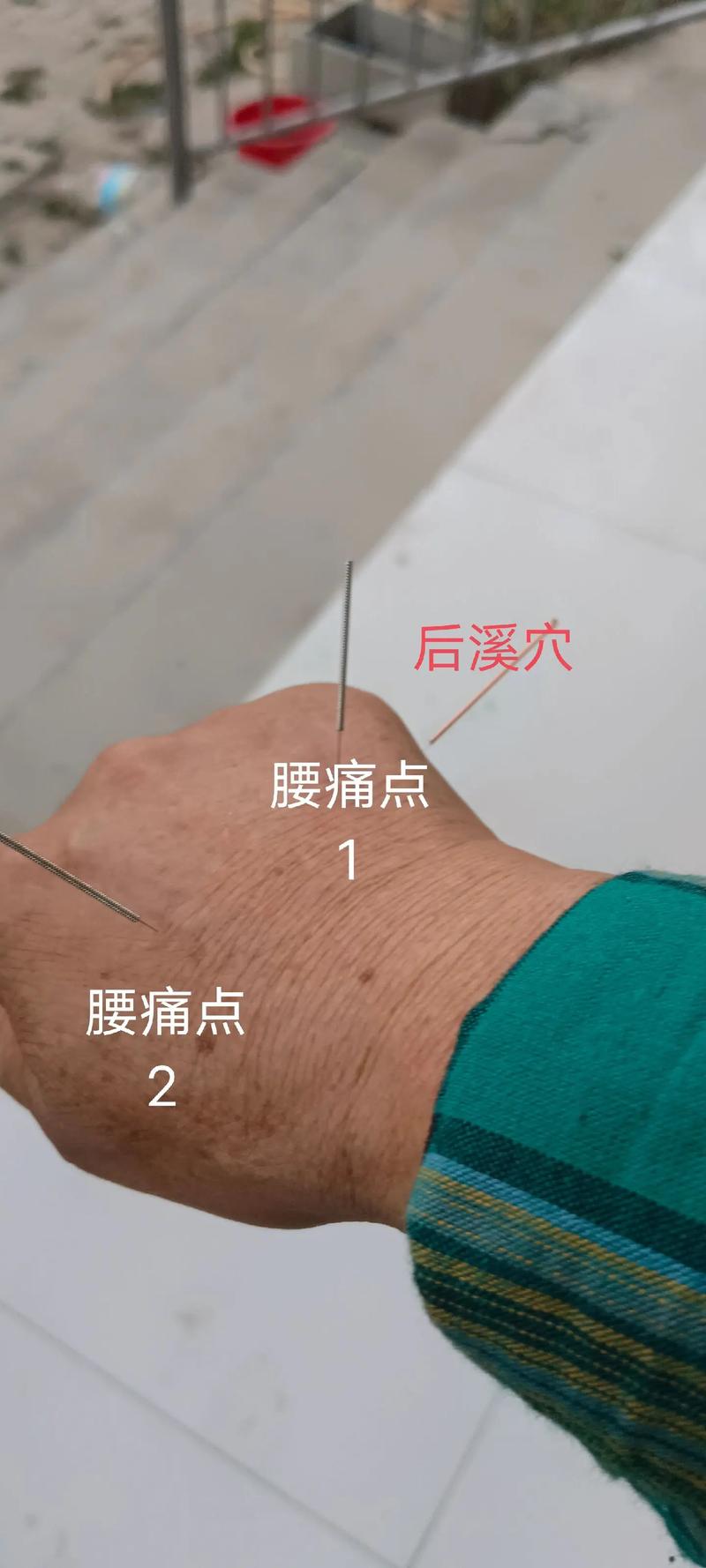 针灸穴位穴位会疼痛吗