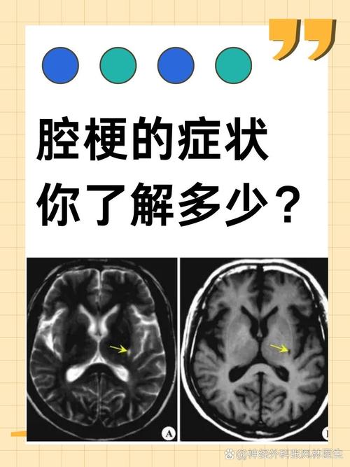 脑梗的腔梗是什么意思