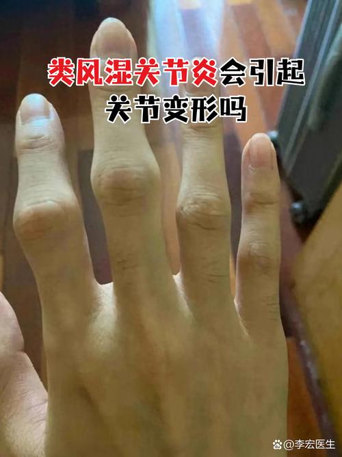 风湿 类风湿骨关节炎