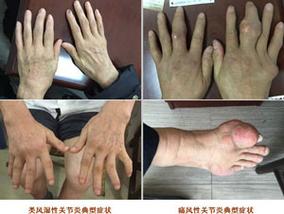 内风湿和痛风湿的区别