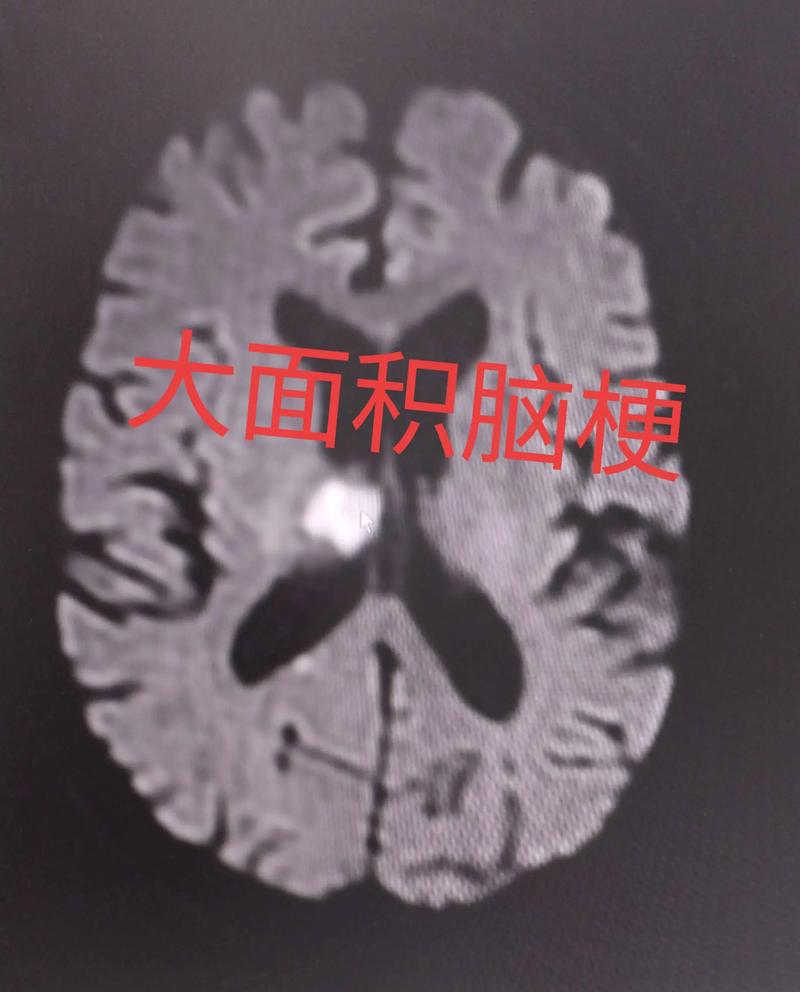 南京市脑科医院看脑梗