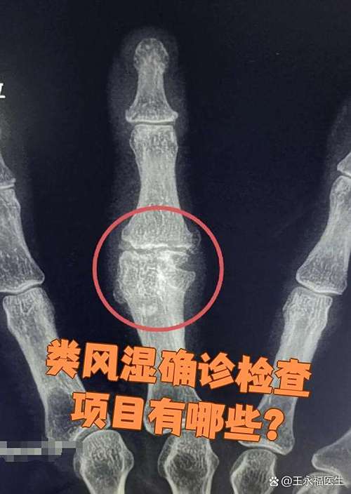 风湿检查能排除风湿吗