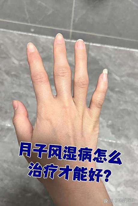 产后风湿会变成风湿吗