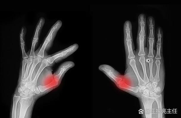 印尼治风湿类风湿风有