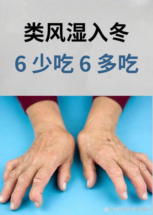 类风湿 风湿病人饮食