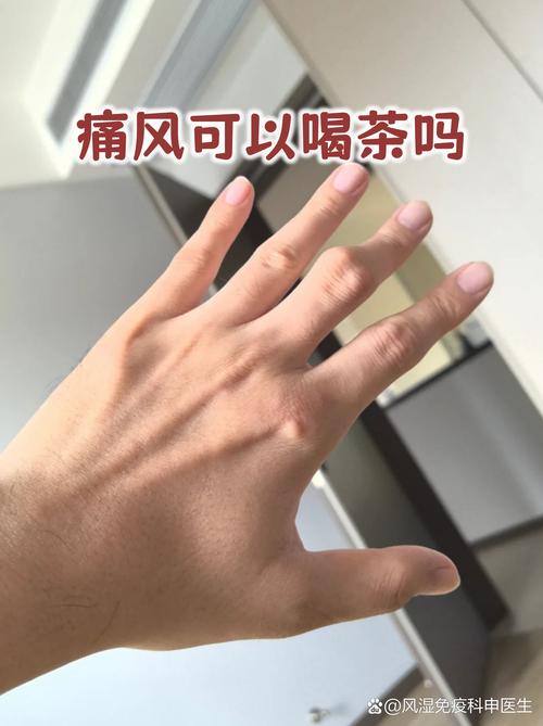 风湿类风湿能喝茶水吗