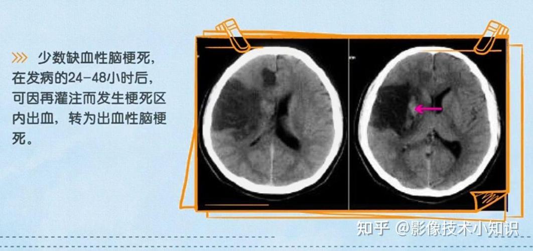 脑CT能查出来脑梗么