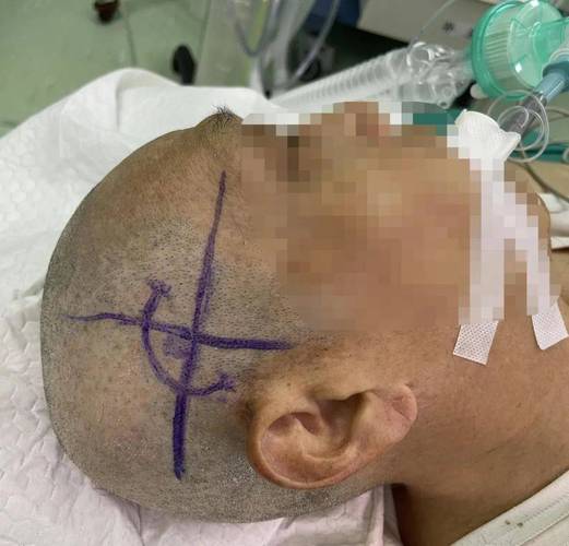 脑疝手术后继发性脑梗