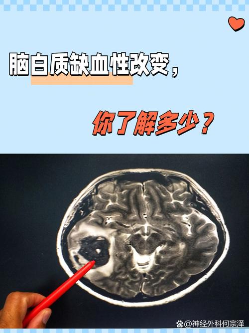 白血病脑梗就是脑白吗