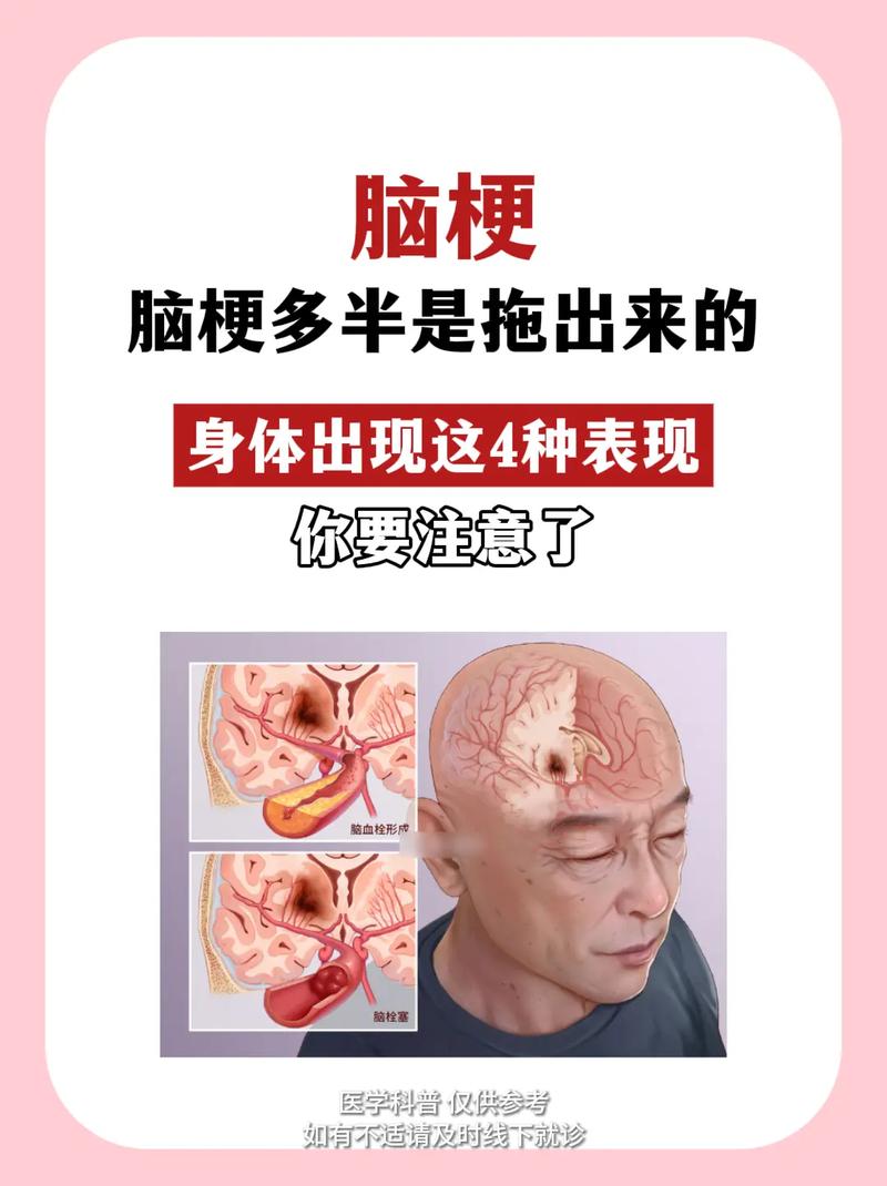 白血病脑梗就是脑白吗