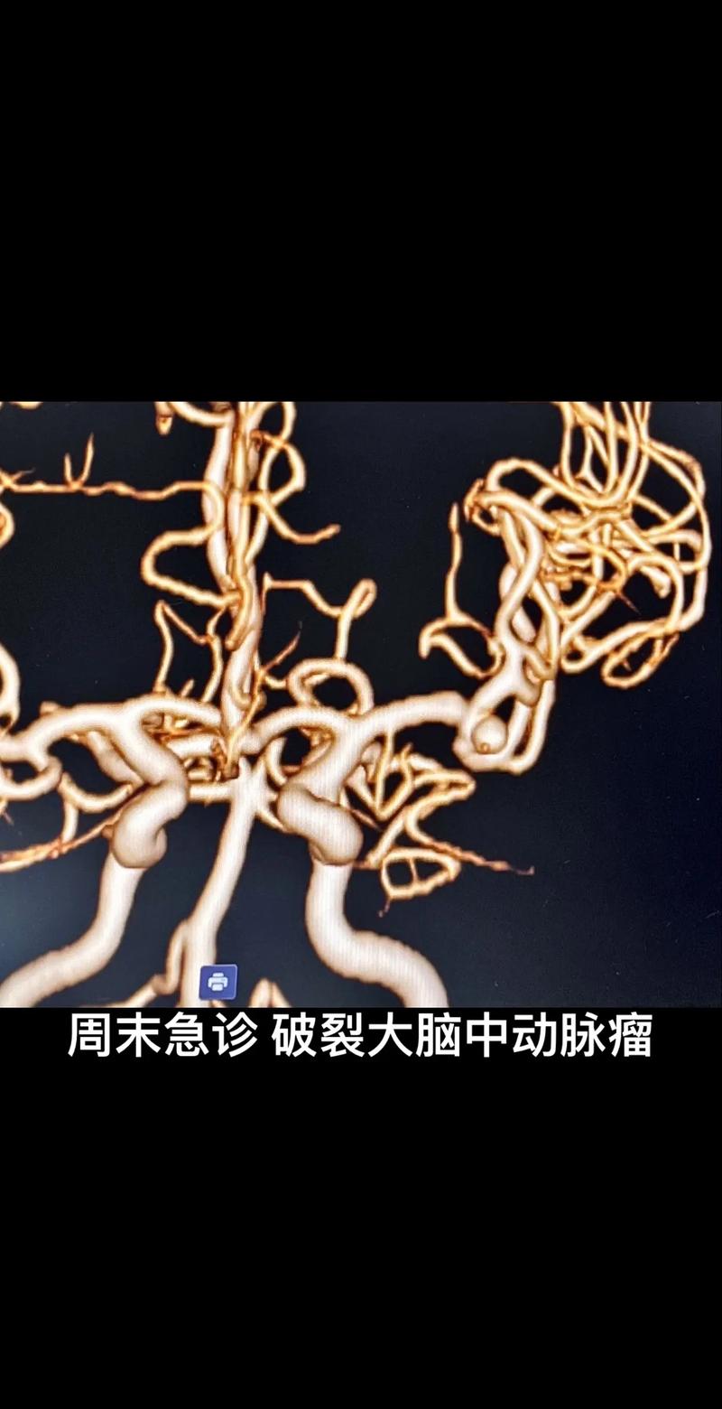 脑动脉瘤与脑梗的关系