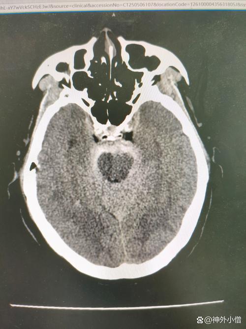 脑核磁有斑点是脑梗吗