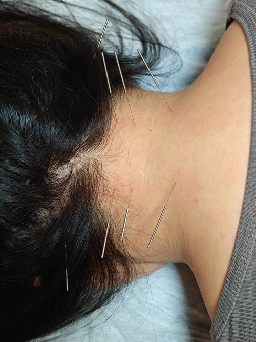 类风湿关节炎针灸穴位