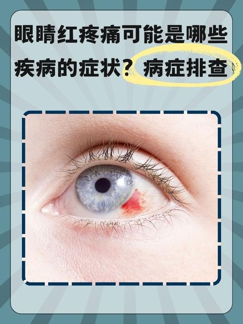 风湿类风湿引起的眼疼