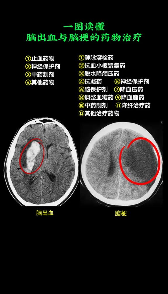 脑梗与腔梗的ct区别
