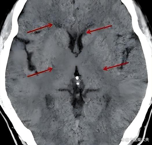 脑梗与腔梗的ct区别