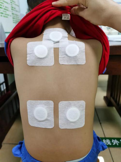 古渗堂穴位贴敷治疗贴