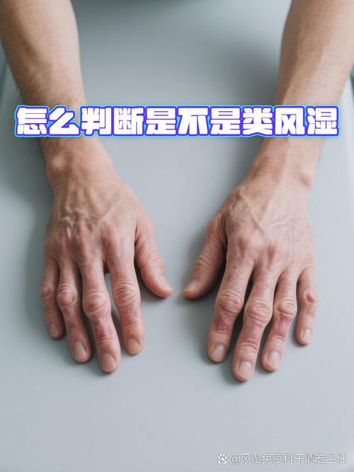 风湿类风湿 两臂发凉