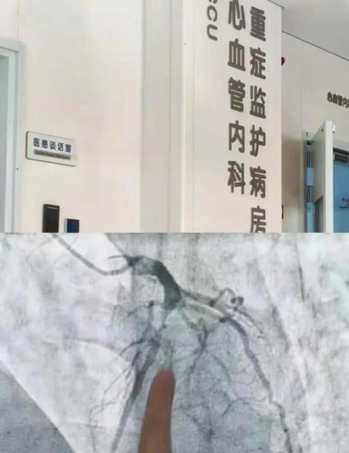 心梗做完支架出现脑梗