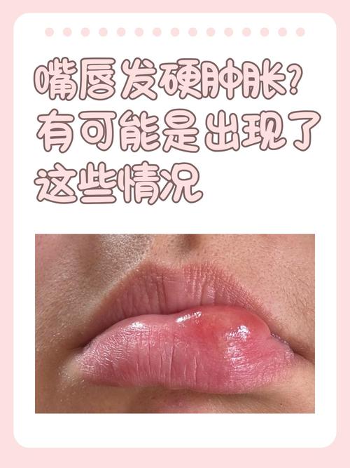 嘴唇紫是心梗还是脑梗