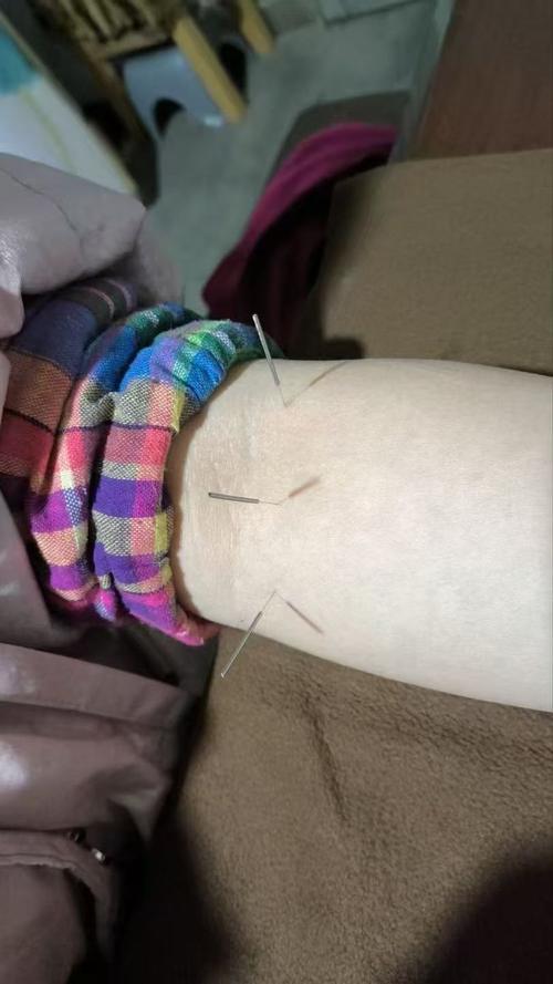 股骨头坏死扎哪些穴位