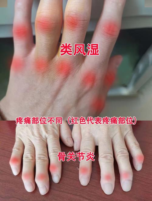 类风湿咋证明是类风湿